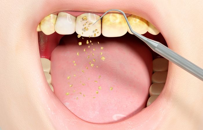 Teeth Scaling